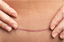 C-Section Recovery Tips: A Complete Guide to Healing After Cesarean Delivery